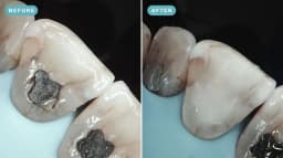 Repairing a cracked tooth behind an old filling